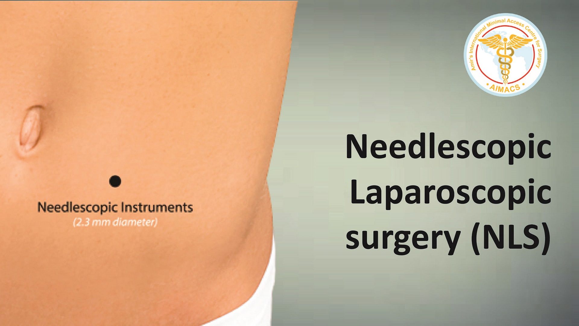 Recovery after Laparoscopic Nissen’s Fundoplication. What to expect